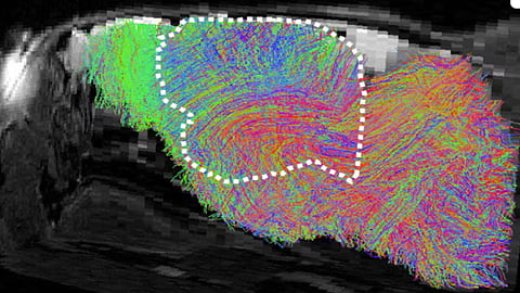 human brain tissue transplanted into mice