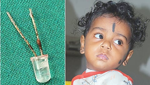 குழந்தை விழுங்கிய எல்.இ.டி. பல்பு. குழந்தை தமிழ்முகிலன்.