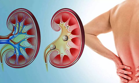 சிறுநீரக செயலிழப்பும் சிகிச்சை முறையும்