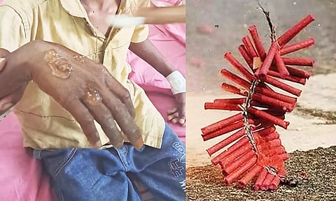பட்டாசு வெடித்து மாணவன் காயம்