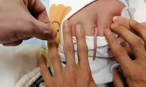 சீனாவில் வாலுடன் பிறந்த ஆண் குழந்தை - என்ன காரணம்?