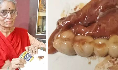 பிறந்தநாள் சாக்லேட்டில் இருந்த செயற்கை பற்கள்