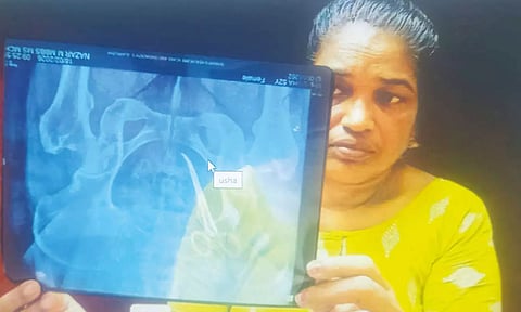 பெண்ணின் வயிற்றில் கத்திரிக்கோல் வைத்து தைத்த அரசு டாக்டர்கள்- 5 ஆண்டுகளுக்கு பிறகு அம்பலம்