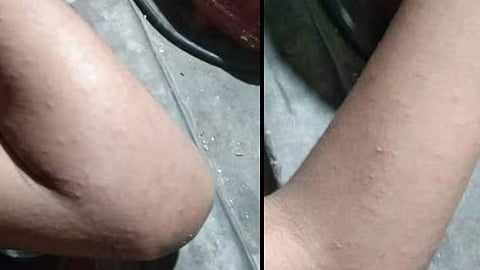 വെഞ്ഞാറമൂട് സർക്കാർ സ്കൂളിൽ നൂറോളം വിദ്യാർഥികൾക്ക് ചൊറിച്ചിലും ശ്വാസം മുട്ടലും; പകർച്ചവ്യാധിയെന്ന് സംശയം