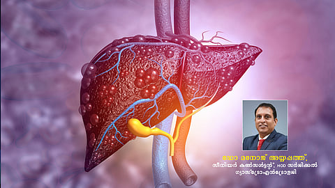 ഫാറ്റി ലിവറും അമിത വണ്ണവും: ജാഗ്രത പുലര്ത്തേണ്ട സമയം