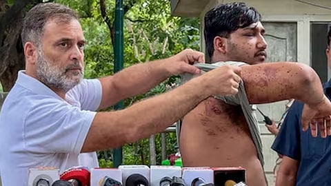 A student injured by a pellet gun during the protests in Delhi, with Leader of the Opposition Rahul Gandhi (File photo).