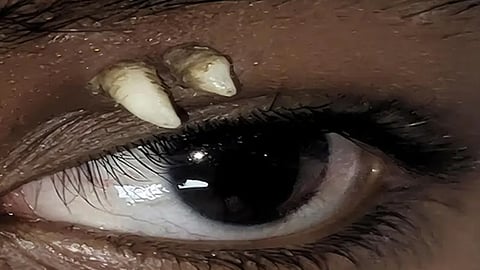 Sharp teeth above the eye; 16-year-old boy suffers from a rare condition