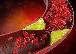 The lesser-known risk factors for heart disease