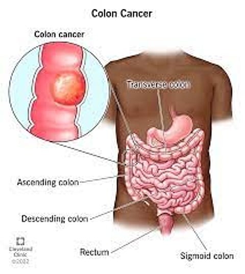 New genetic risks for colon cancer found by scientists