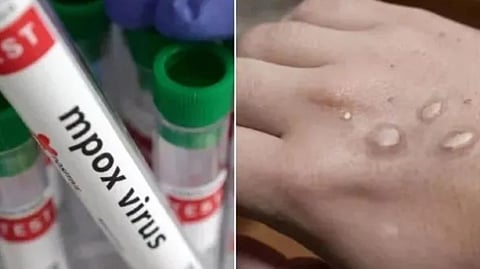Kerala reports second monkeypox case in India amid global outbreak
