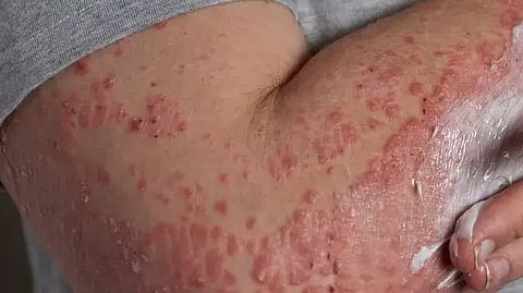 Subacute Cutaneous Lupus