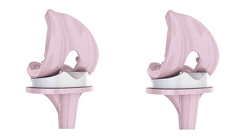 Aster Medcity Performs Total Ceramic Knee Replacement for the First Time in Kerala, Offering a Lifetime Solution for Active Patients