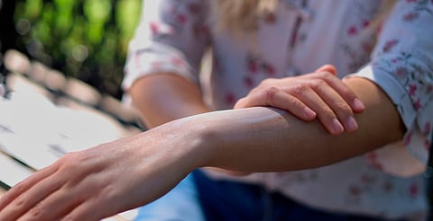 Exposición solar frecuente, factor de riesgo del cáncer de piel: SSM
