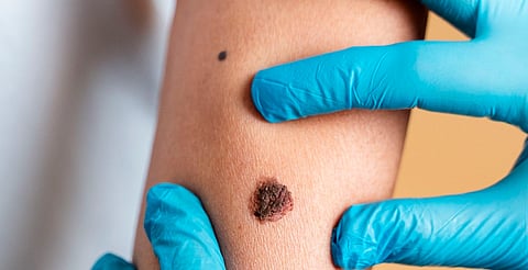 Aprueba Cofepris ensayo clínico para vacuna innovadora contra melanoma