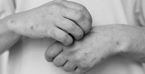 Primeras muertes por sarampión desde 1992