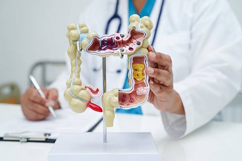 Cáncer de colon en hombres jóvenes crece; UNAM estudia posible causa