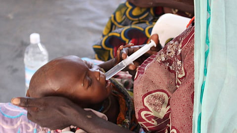 Niño afectado por desnutrición severa en un hospital de Nigeria (Foto: OCHA/O.Fagan)