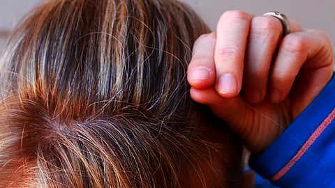 El estrés sobreactiva determinados nervios del sistema nervioso autónomo que, provocan un daño permanente a las células madre de melanocitos
(Foto: Pixabay)