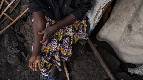 Sarah Bagheni, in the Bulengo refugee camp in Goma, Congo, suspects she may be infected with Mpox after the World Health Organization had declared Thursday, Aug, 15, 2024, the increasing spread of mpox in Africa a global health emergency, warning the virus might ultimately spill across international borders.