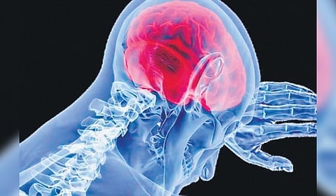 Meningitis is an infection and swelling, called inflammation, of the fluid and membranes around the brain and spinal cord.