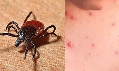 The illness is caused by the bacterium Orientia tsutsugamushi and spreads through the bite of infected chigger mites that thrive in tall grass, scrub forests, and dense vegetation.