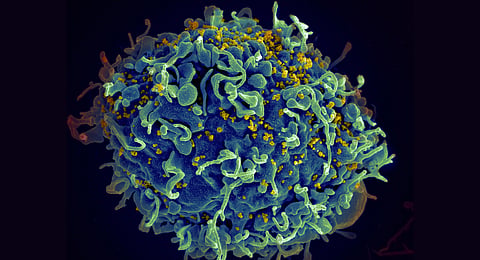 This colorized electron microscope image provided by the U.S. National Institutes of Health shows a human T cell, in blue, under attack by HIV, in yellow, the virus that causes AIDS.