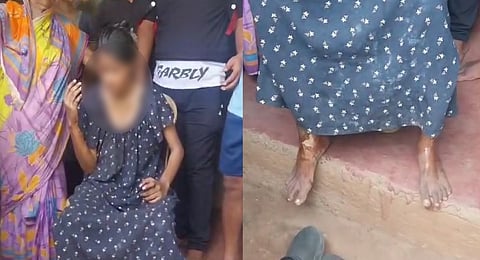 The minor girl who suffered serious burns was rescued by local people before she was shifted to AIIIMS-Bhubaneswar. She belongs to a minority community.
