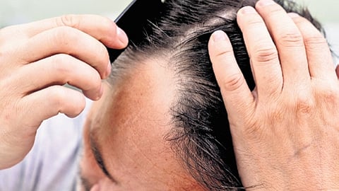 Notably, the study has also identified the role of cholesterol intermediates in governing hair follicle regeneration.