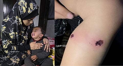 According to a medical report cited by the TRT World, the child suffered burn marks from cigarettes and puncture wounds in his leg caused by the nail.