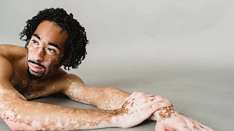Changing the narrative around Vitiligo