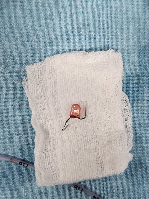 KIMS doctors successfully remove LED bulb from childs lung