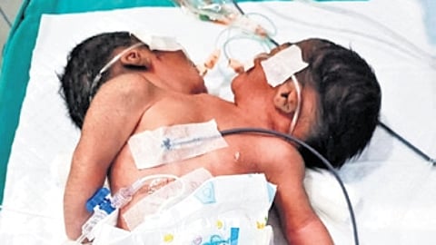 The newborn conjoined twins