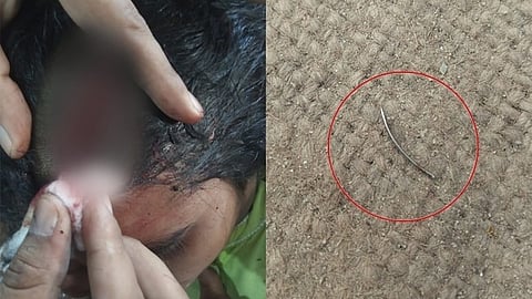 മുറിവ് തുന്നിക്കെട്ടി, പിറകെ സൂചി രോഗിയുടെ തലയ്ക്കുള്ളിൽ വച്ച് മറന്ന് ഡോക്ടർ; അന്വേഷണം ആരംഭിച്ച് ആരോഗ്യവകുപ്പ്