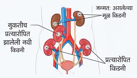 चेन्नईतील व्यक्तीवर तिसर्यांदा किडनी प्रत्यारोपण