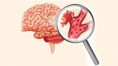 कोरोनाच्या तिसर्या लाटेत ‘ब्रेन स्ट्रोक’चा मोठा धोका, तुटताहेत मेंदूतल्या नसा!