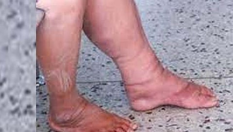 Elephantiasis microorganisms