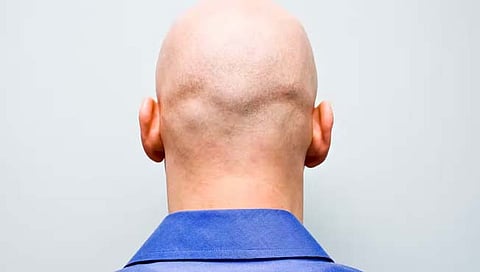 Bald : ऑफीसमध्ये कर्मचार्याला ‘टकल्या’ म्हणणे हे लैंगिक अत्याचारासारखेच! : ‘या’ देशाच्या कोर्टाचा निकाल