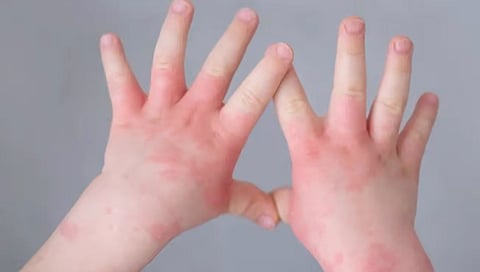 Tomato Flu : कोरोना आणि मंकीपॉक्सनंतर आता ‘टोमॅटो फ्लू’ या नव्या आजाराची साथ