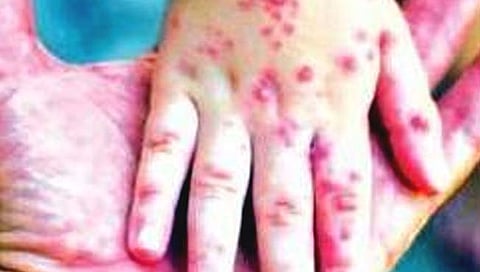 ठाणे : भिवंडीत गोवरचा प्रकोप; तब्बल ७९३ संशयित रुग्ण
