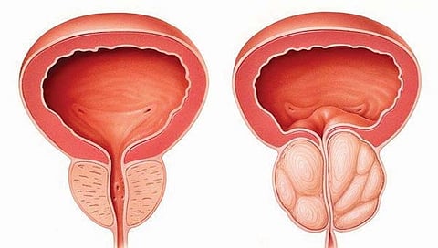 Prostate problems : आयुर्वेद उपचार, आहार आणि पथ्य जाणून घ्या सविस्तर