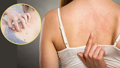 sweat pimples