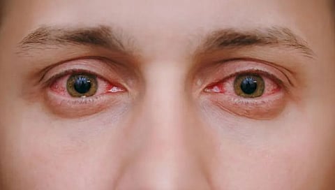 Eye flue
