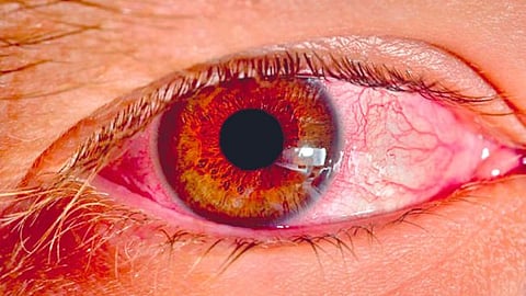 Eye Allergy