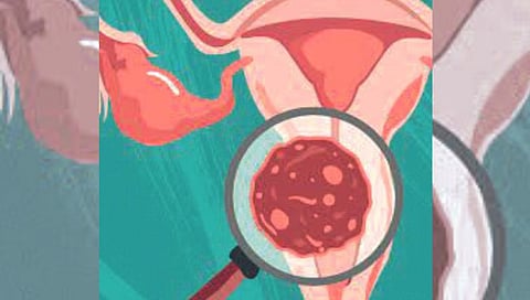 Cervical Cancer