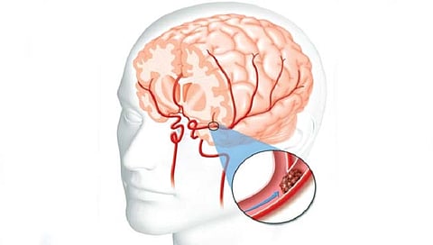 Brain stroke
