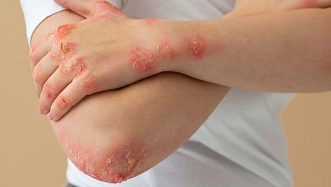 Leptospirosis