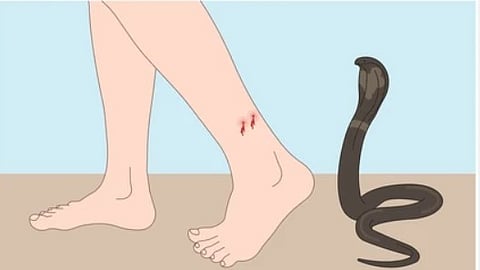 Snakebite