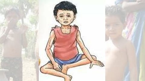 Malnourished Child