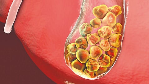 Gallstones treatment |