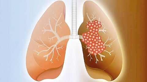 Idiopathic pulmonary fibrosis